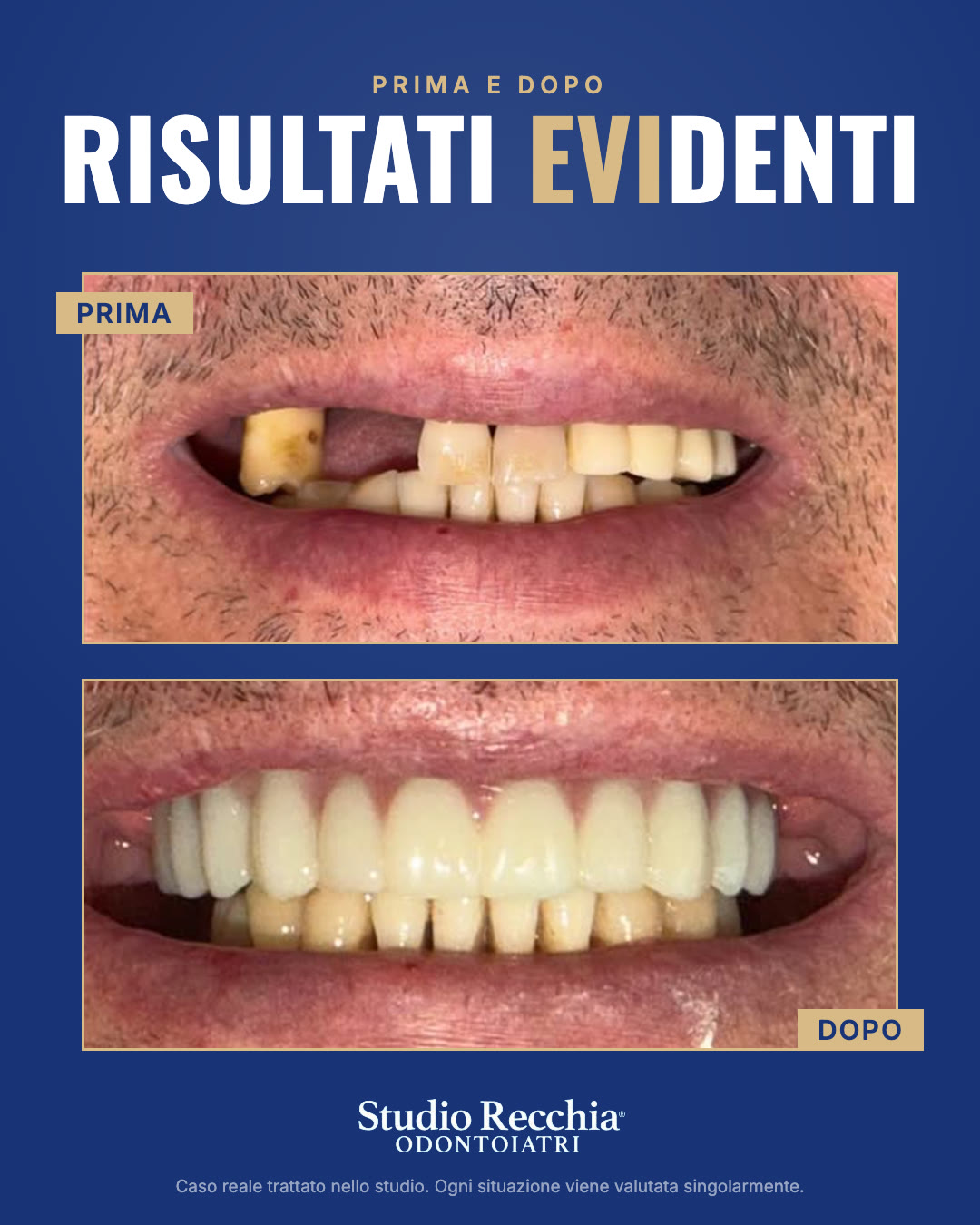 Prima e dopo: Chirurgia guidata