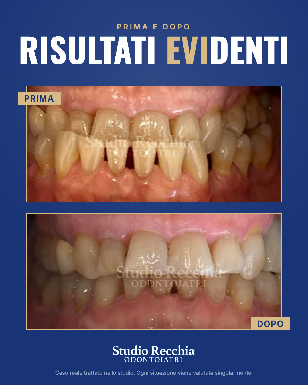 Prima e dopo: Riabilitazione dell'arcata superiore